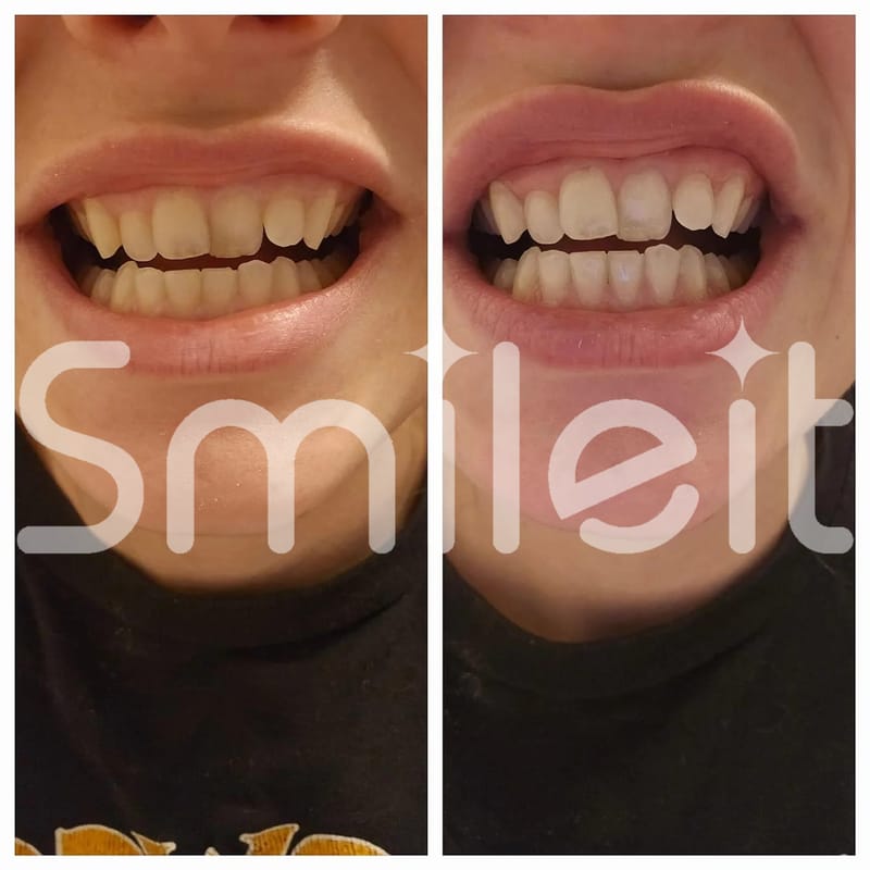 Customer photo review of פורמולת ההלבנה האינטסיבית של סמיילית