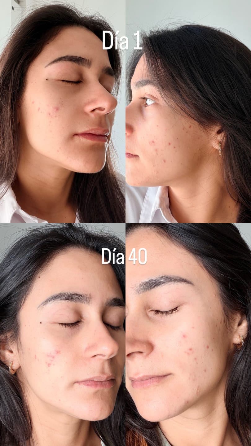 Customer photo review of A CONTROL - ACNÉ HORMONAL & RESISTENCIA A LA INSULINA