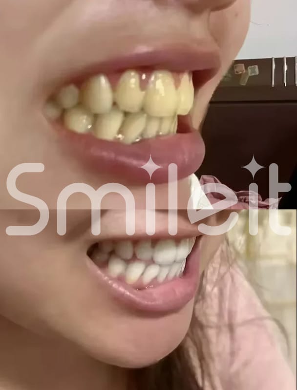 Customer photo review of פורמולת ההלבנה האינטסיבית של סמיילית