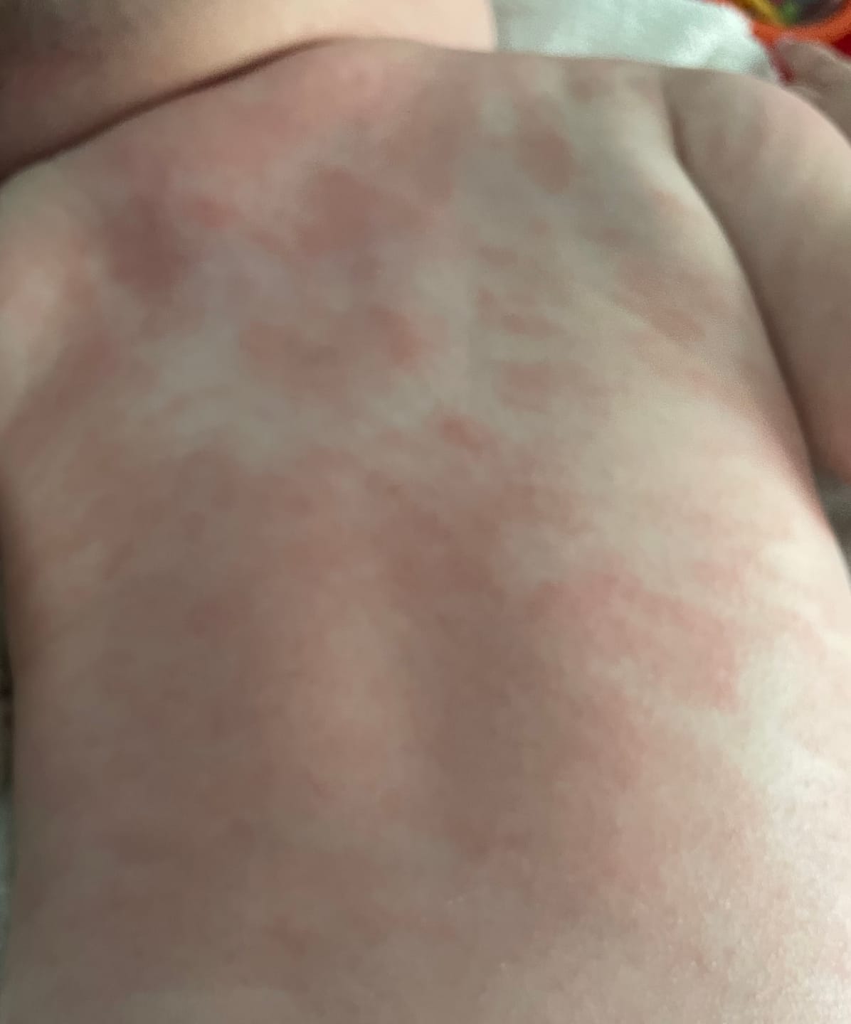 Customer photo review of Bioskin Junior Duo Pack