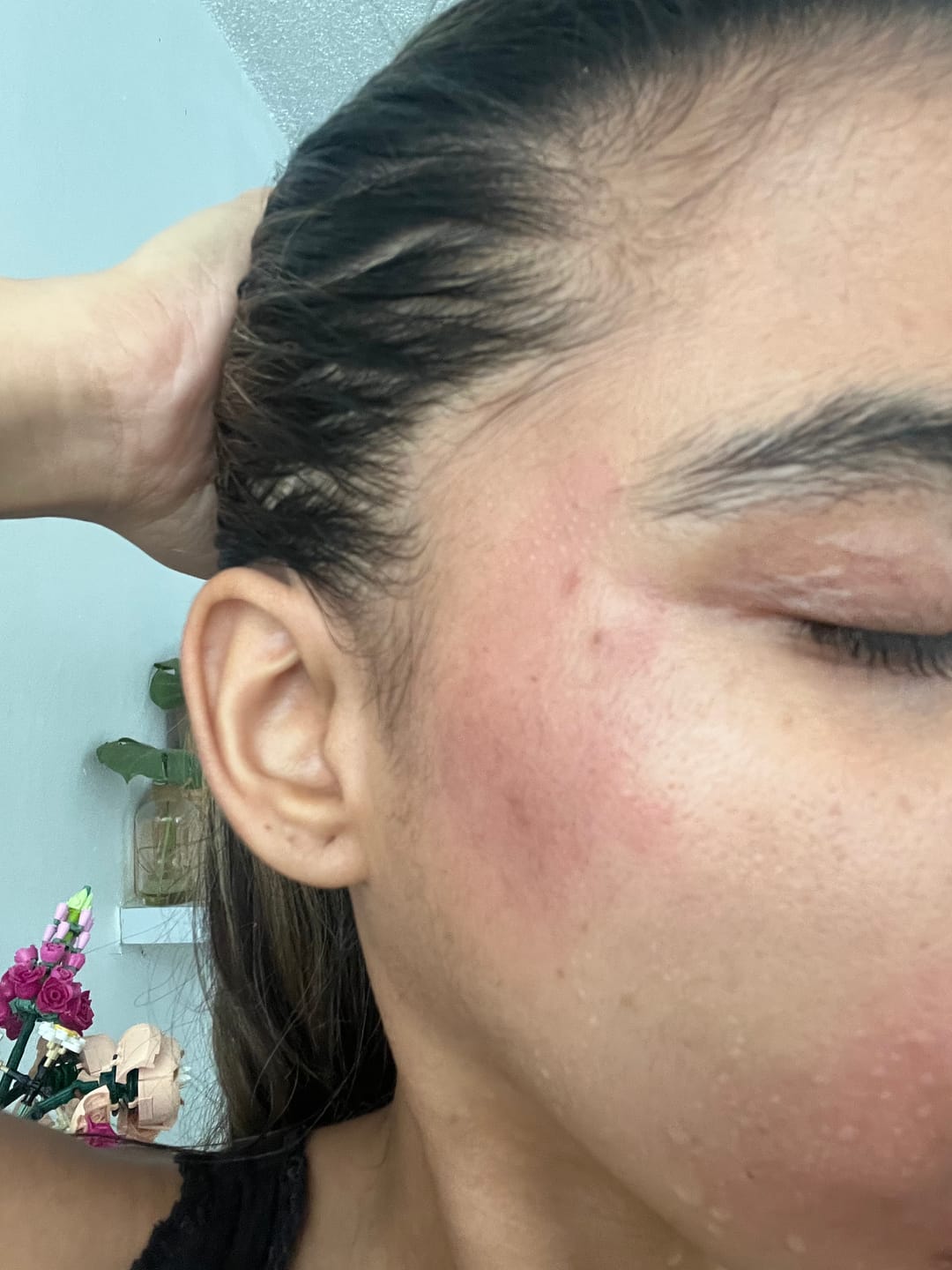 Customer photo review of Scrachee's Flare Up Relief Bundle