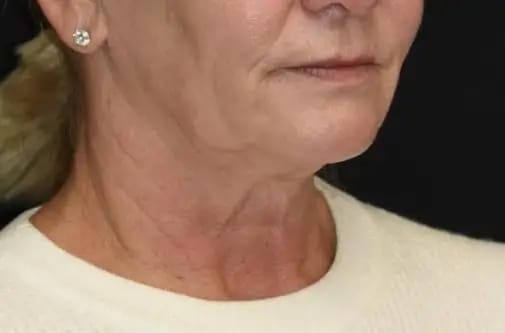 Customer photo review of DermaSculpt Pro - By Oracitive™