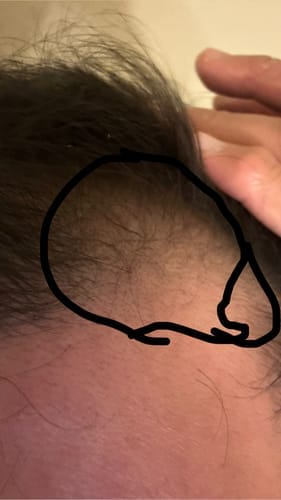 Customer photo review of Sérum Anticaída de Doble Acción | Hair Biolabs™