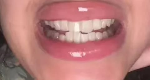 Customer photo review of Bandes Blanchissantes Kimby™