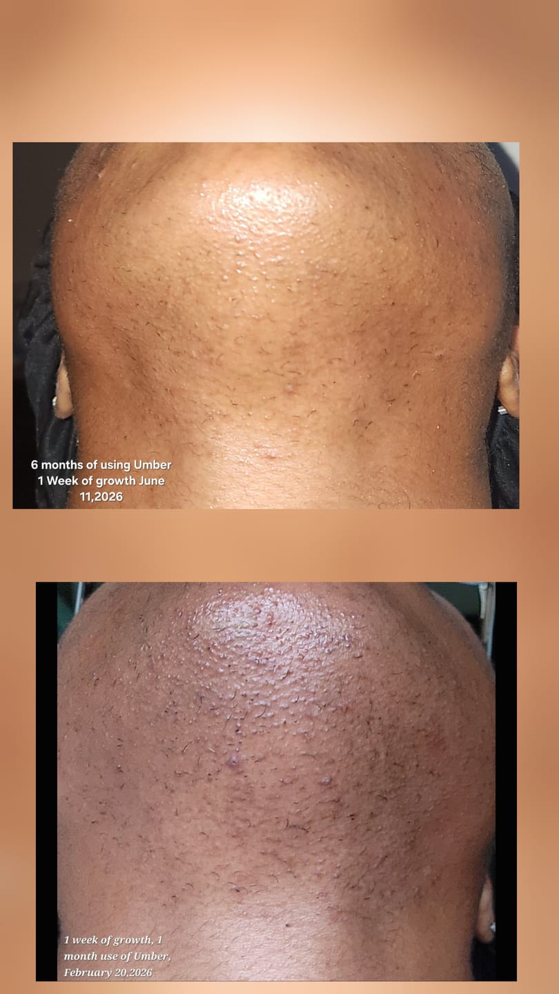 Customer photo review of Hair Reducing Fade Oil - Slows Growth, Thins, and Reduces Hair Naturally