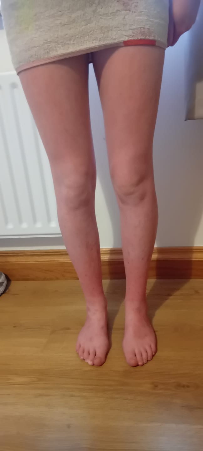 Customer photo review of Large Bioskin Junior Duo Pack