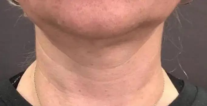 Customer photo review of DermaSculpt Pro - By Oracitive™