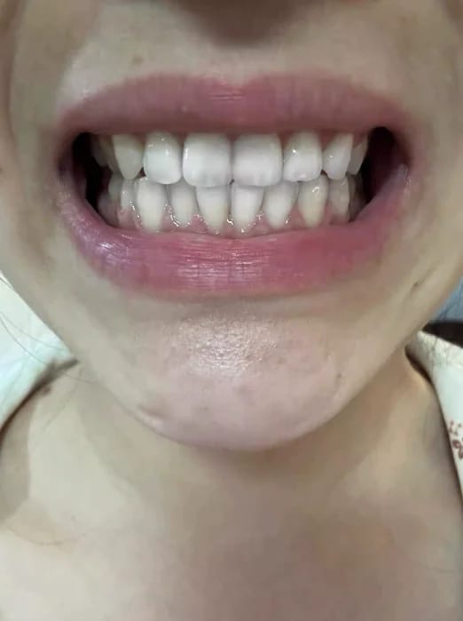 Customer photo review of Bandes Blanchissantes Kimby™
