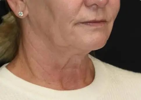 Customer photo review of DermaSculpt Pro - By Oracitive™