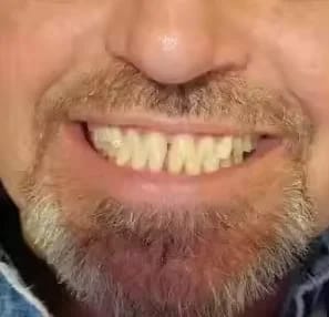 Customer photo review of Bandes Blanchissantes Kimby™
