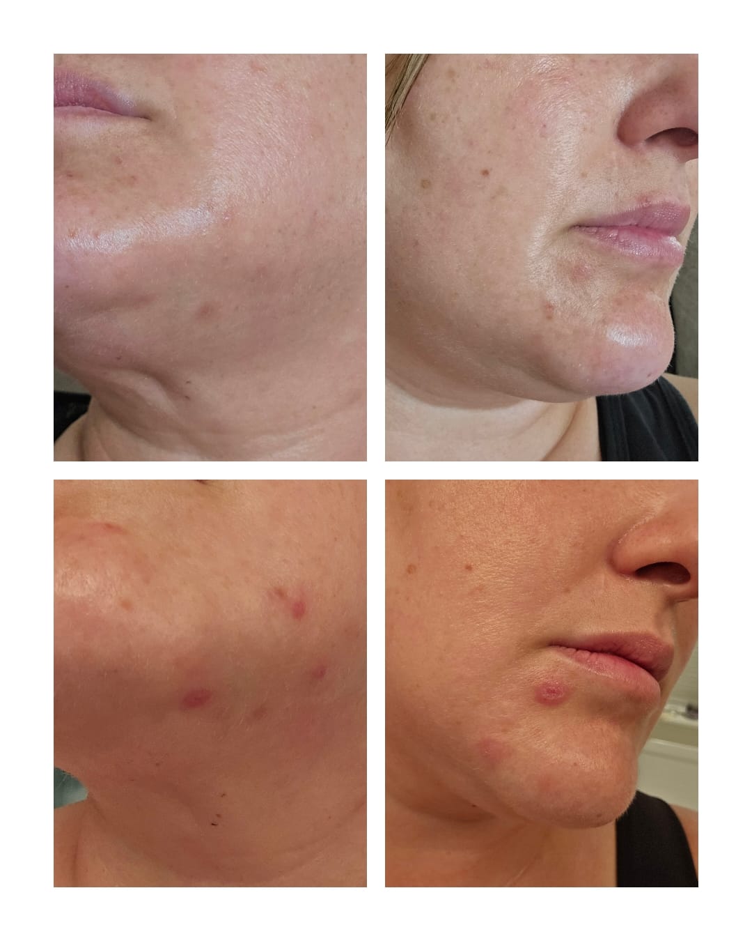 Customer photo review of BeautyPro 2.0 - High Frequency Wand