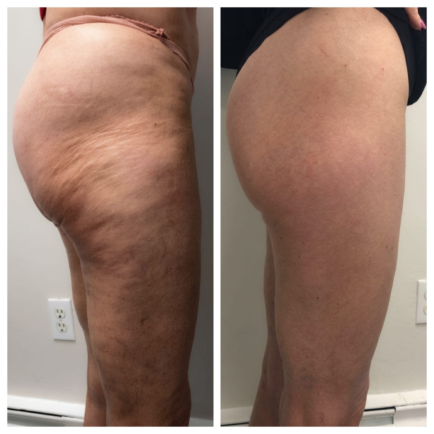 Customer photo review of Vacuvia® SculptGlow™ – Firmer, More Toned Skin