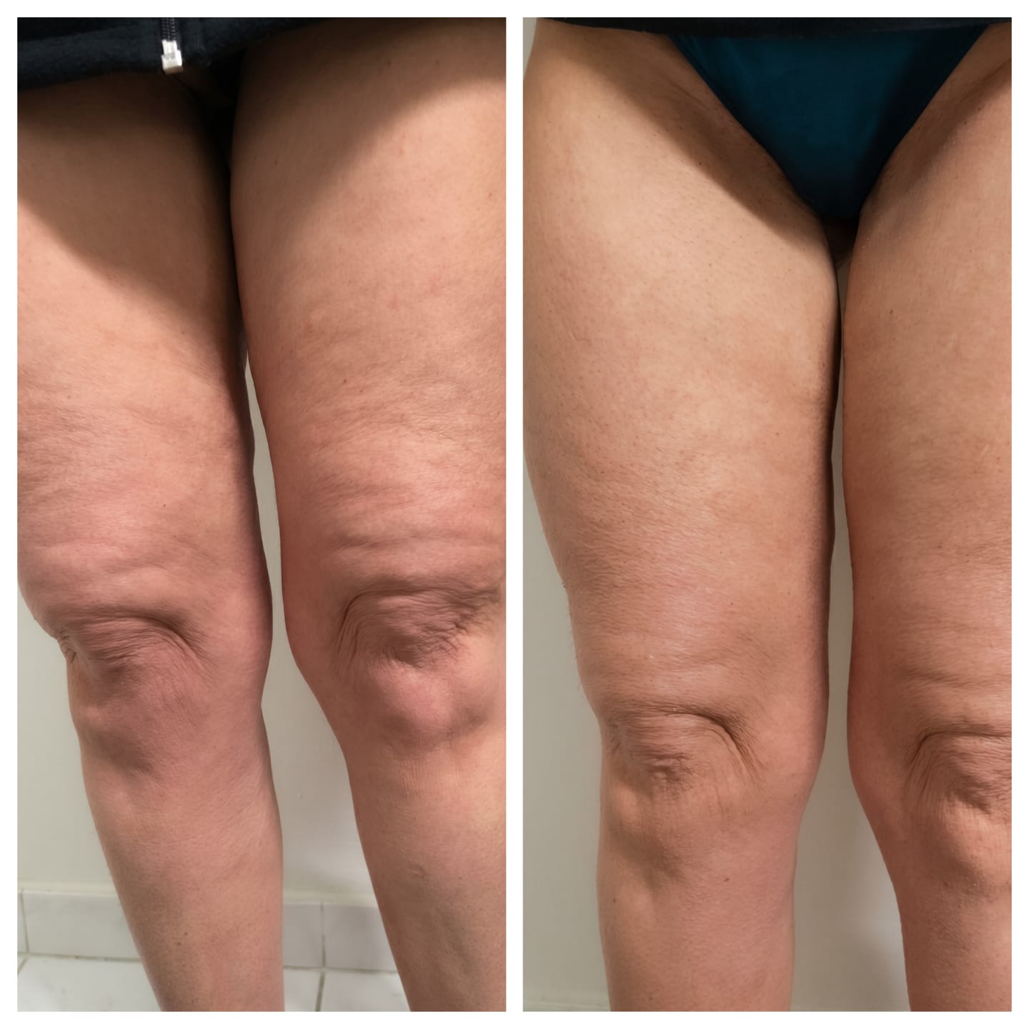 Customer photo review of Vacuvia® SculptGlow™ – Firmer, More Toned Skin