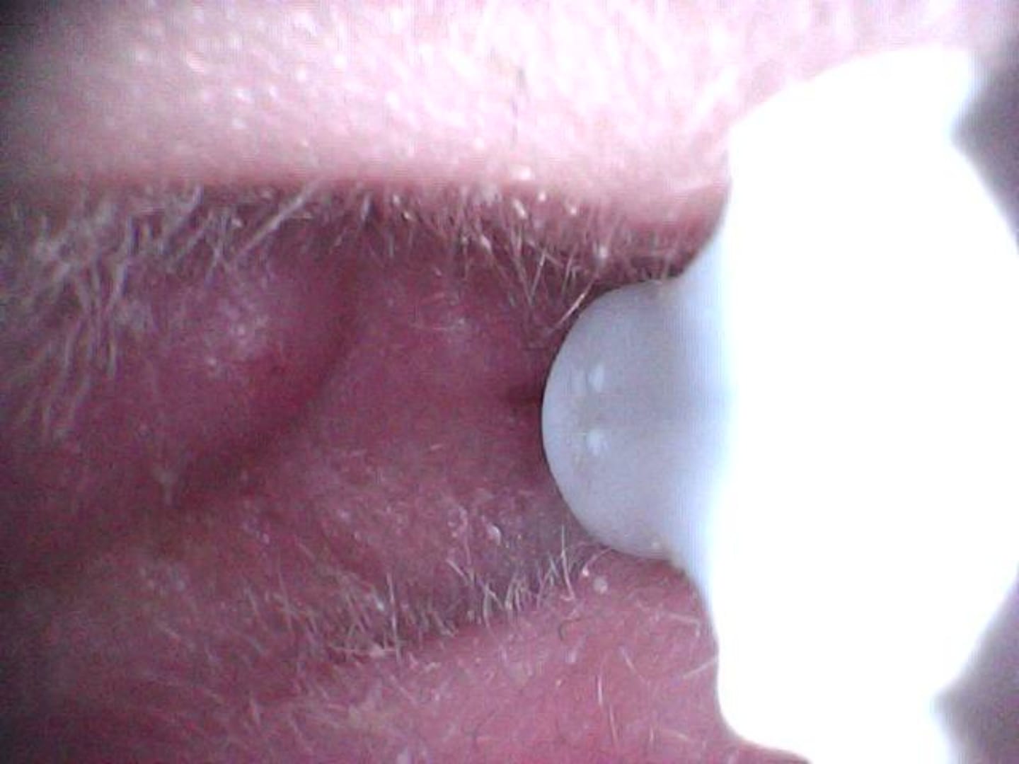 Customer photo review of ClearEar™ Earwax Removal Kit