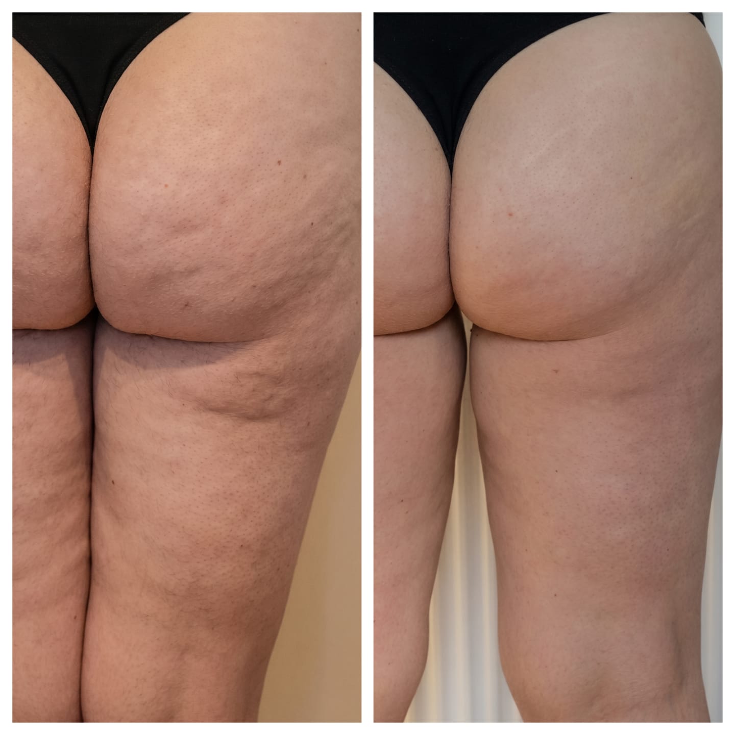 Customer photo review of Vacuvia® SculptGlow™ – Firmer, More Toned Skin