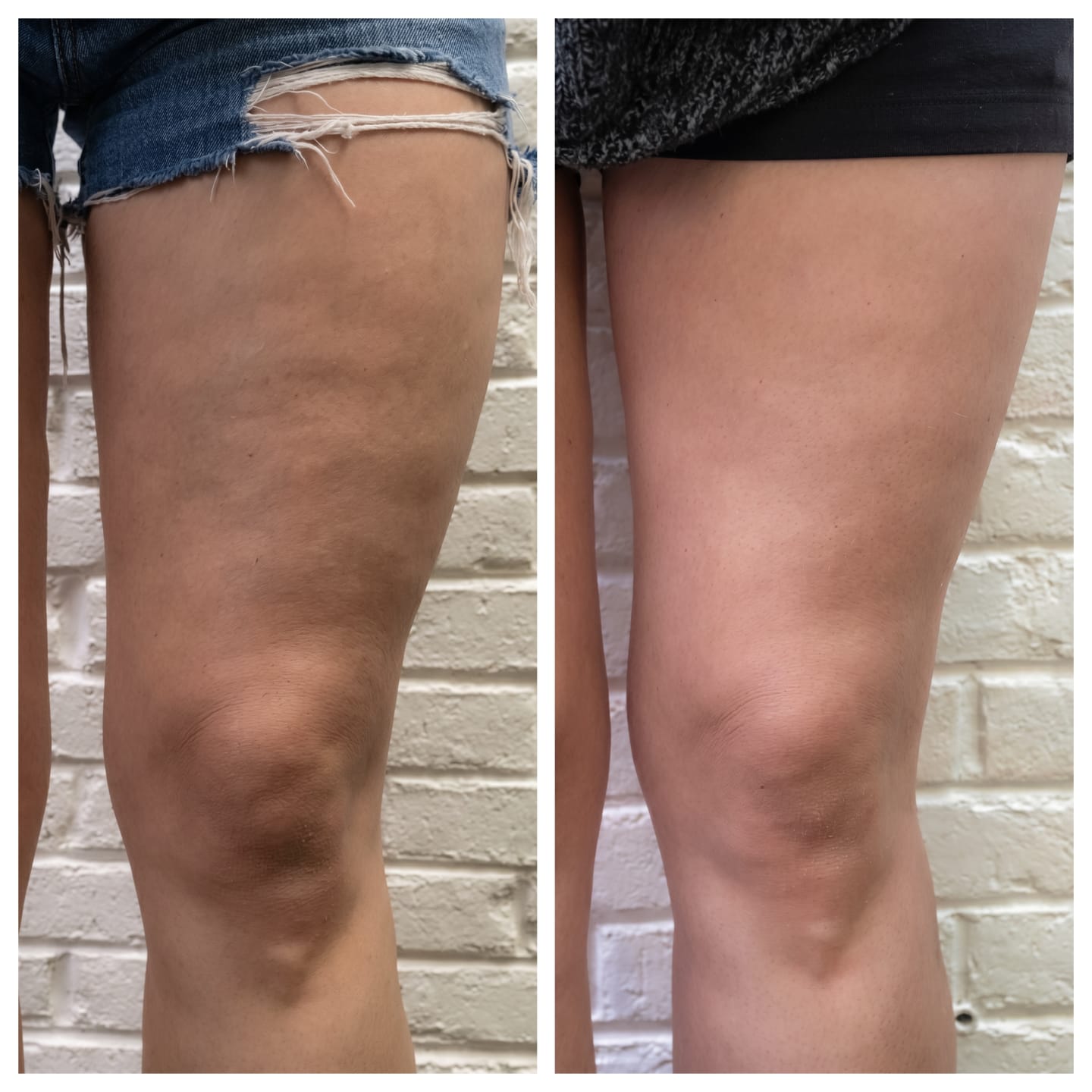 Customer photo review of Vacuvia® SculptGlow™ – Firmer, More Toned Skin
