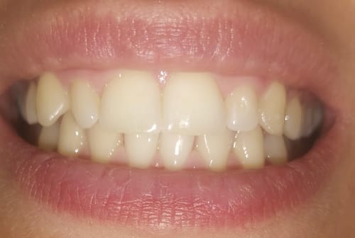 Customer photo review of GlorySmile™ V34 Whitening Toothpaste (30 ml)