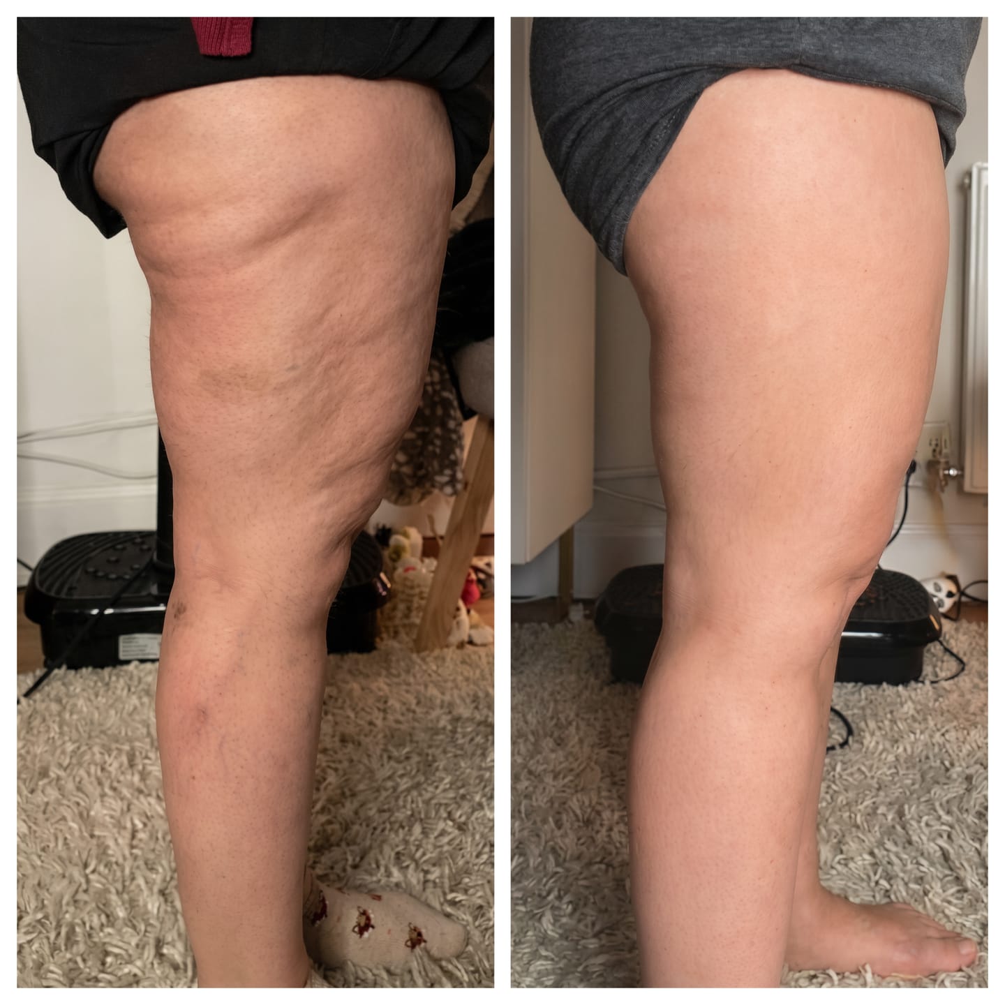 Customer photo review of Vacuvia® SculptGlow™ – Firmer, More Toned Skin