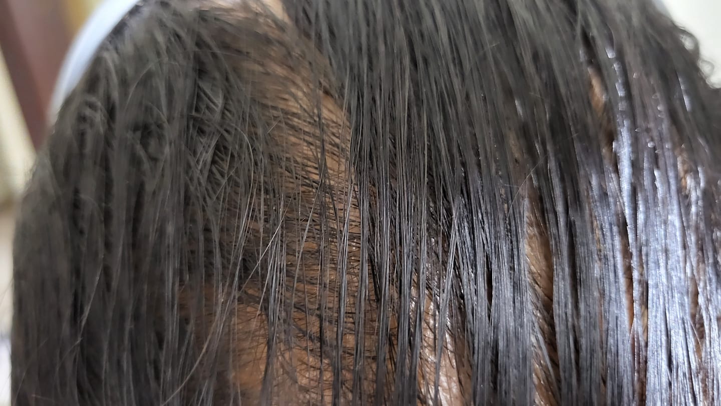 Customer photo review of Advance Hair Growth Serum 2.0 (30ml)