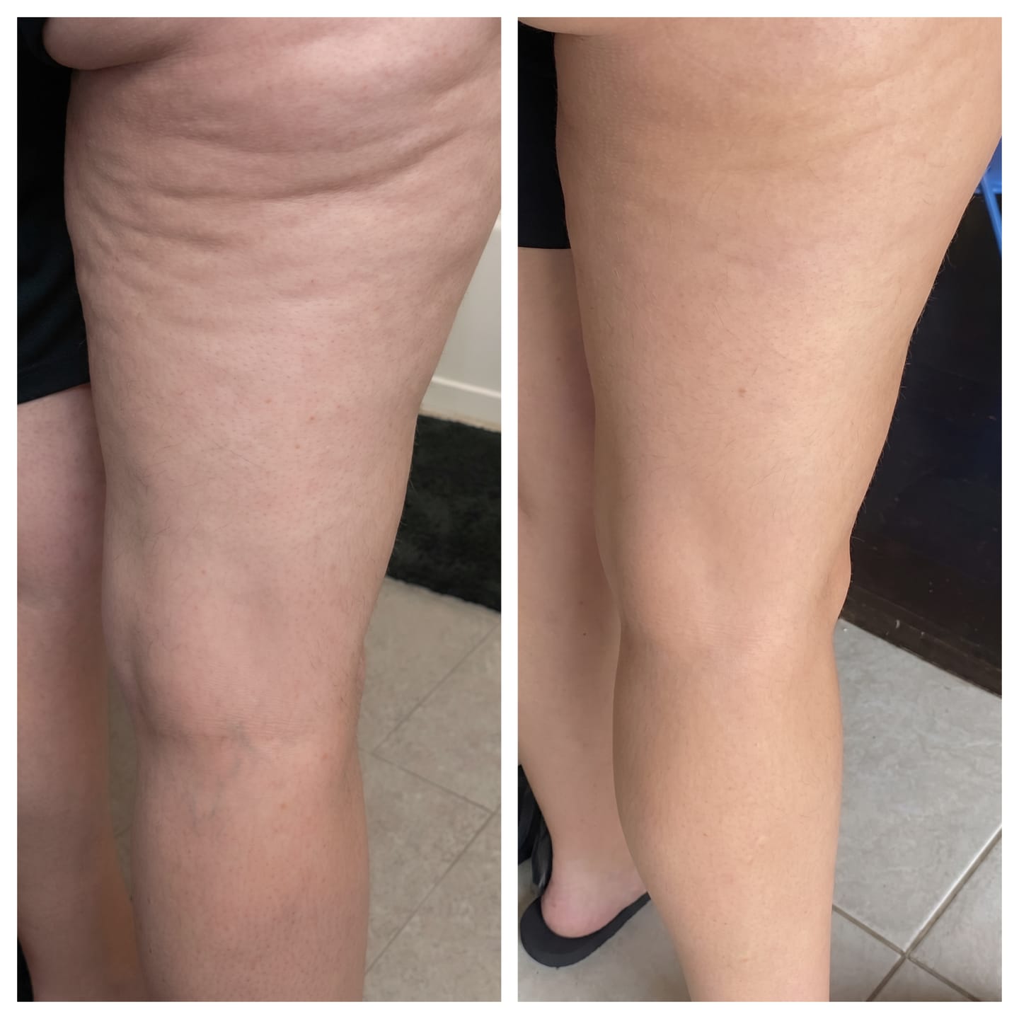 Customer photo review of Vacuvia® SculptGlow™ – Firmer, More Toned Skin