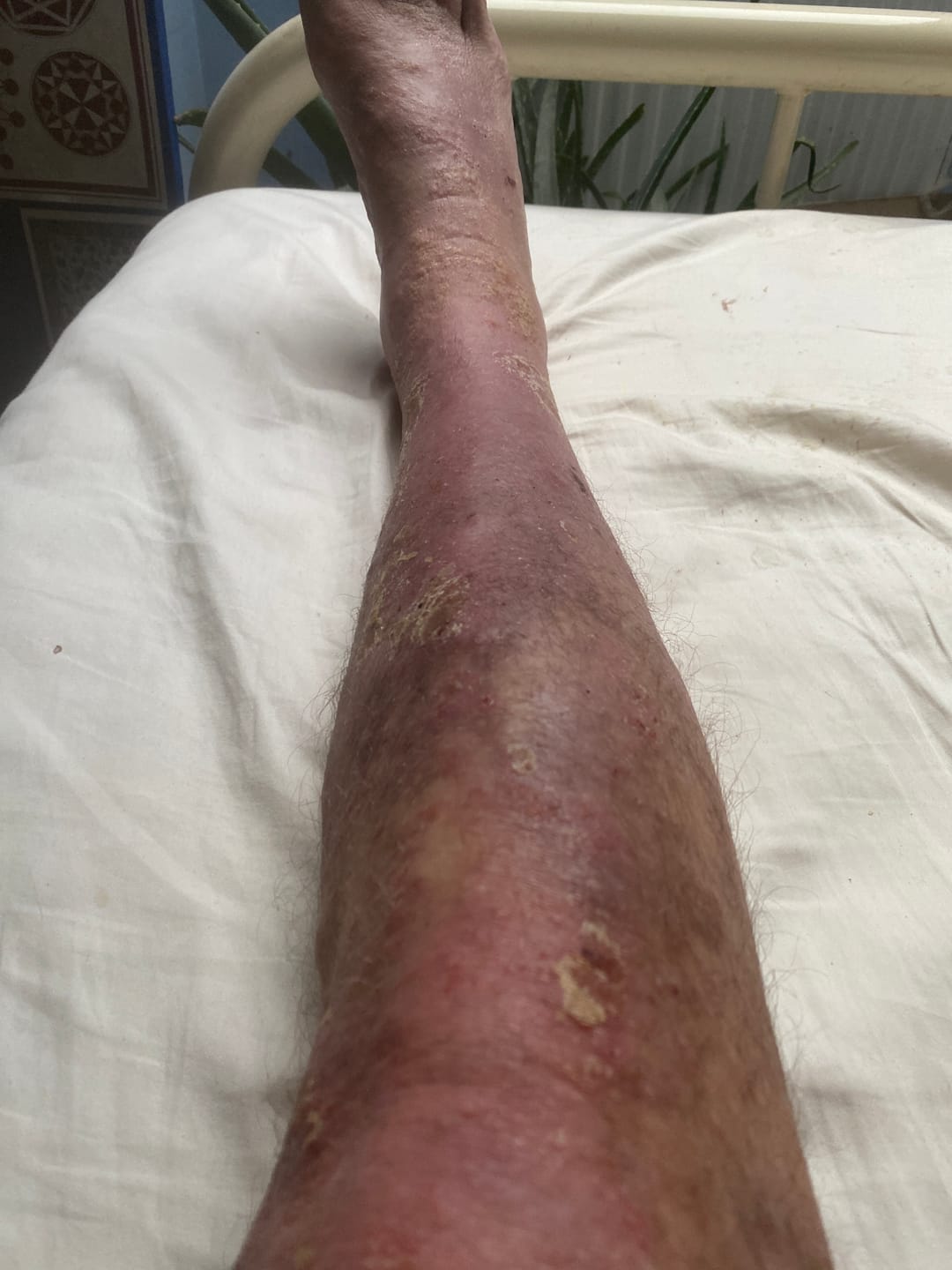 Customer photo review of Bioskin Zeoderm Skin Repair Moisturiser