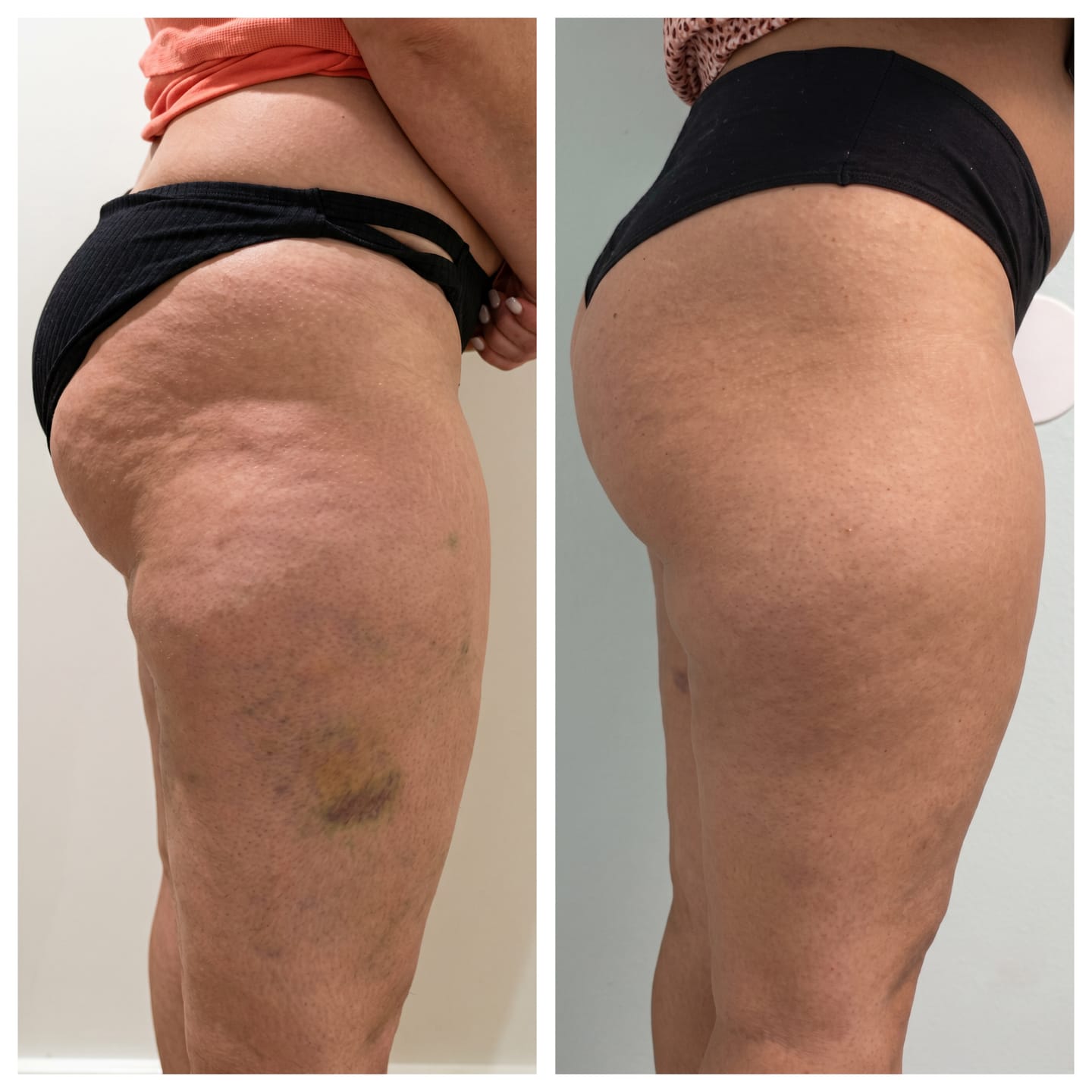 Customer photo review of Vacuvia® SculptGlow™ – Firmer, More Toned Skin