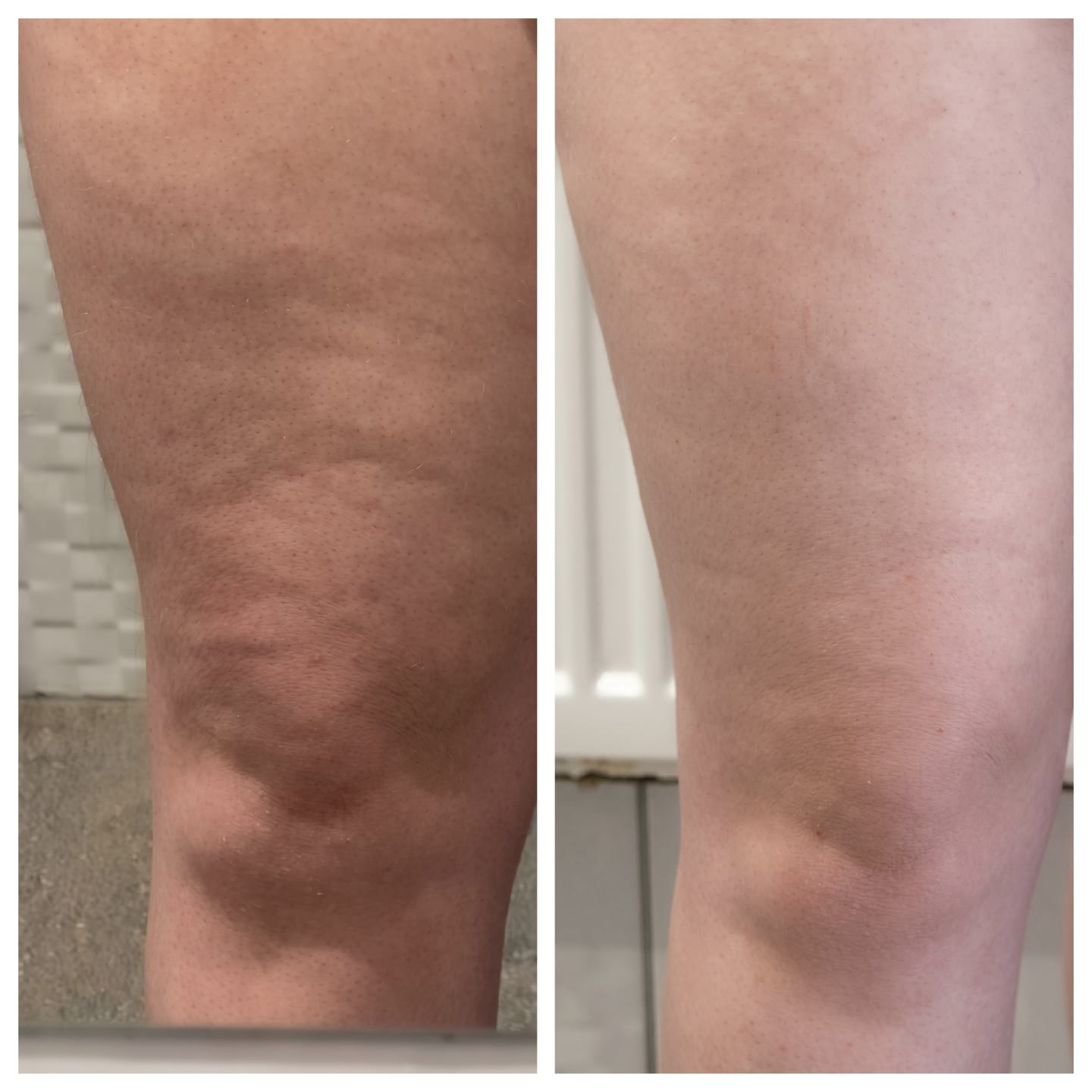 Customer photo review of Vacuvia® SculptGlow™ – Firmer, More Toned Skin
