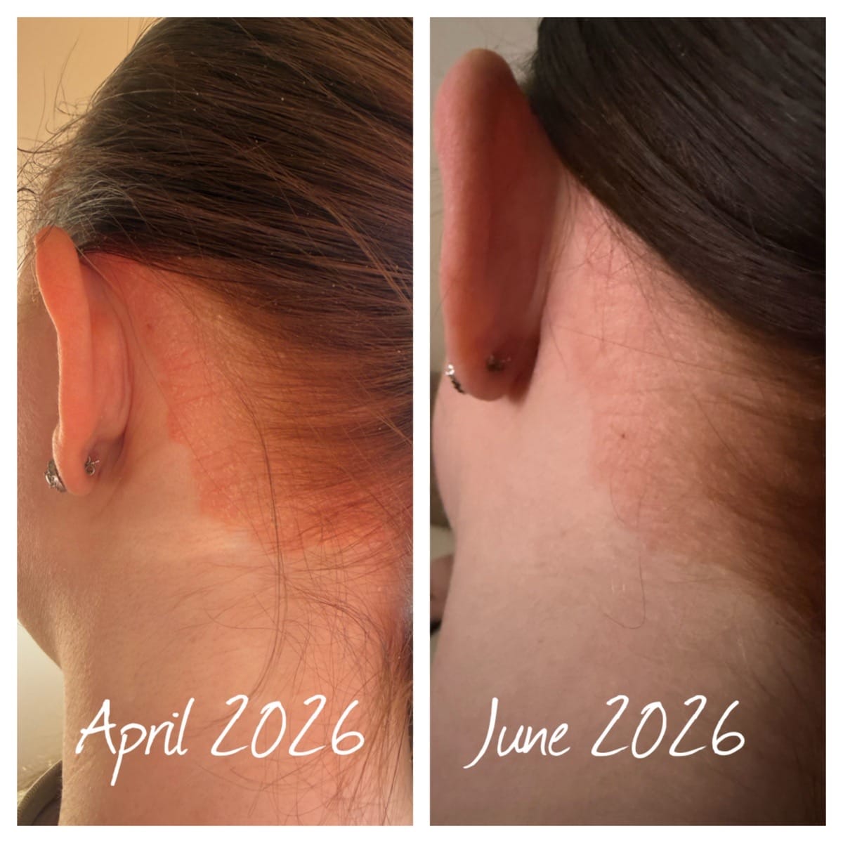 Customer photo review of Calm Skin-Relief Kit
