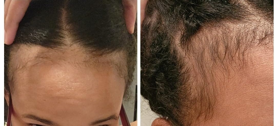Customer photo review of KosmaHair Sérum | Restaurador Capilar & Entradas
