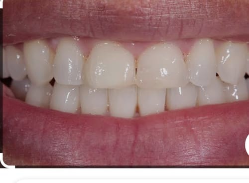 Customer photo review of GlorySmile™ V34 Whitening Toothpaste (30 ml)