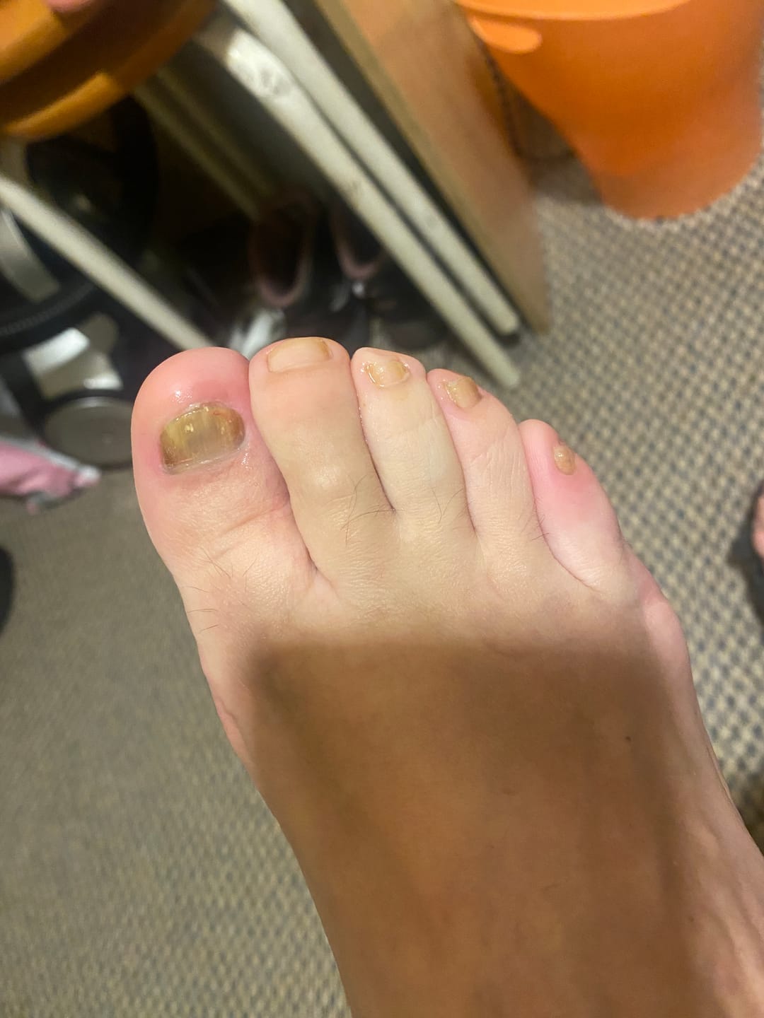 Customer photo review of Gotas ByeBye Hongos – Uñas Sanas & Fuertes