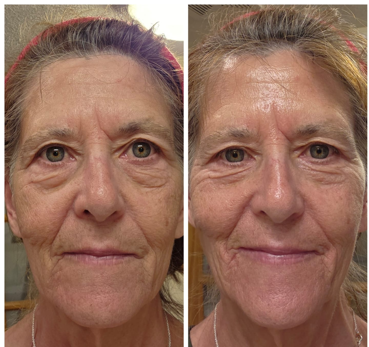 Customer photo review of The Micro Infusion System™