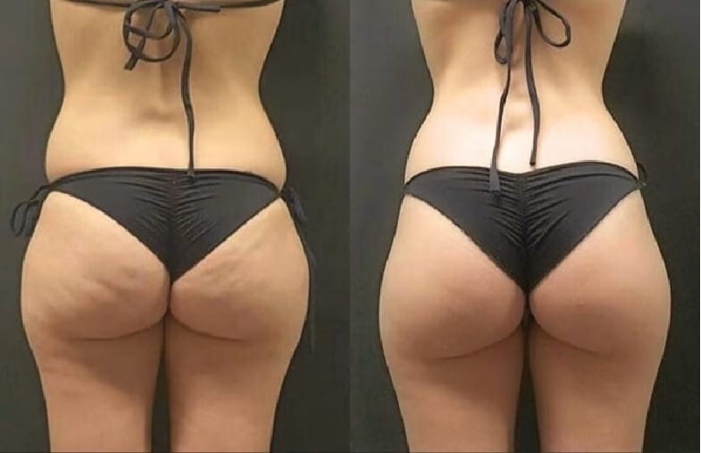 Customer photo review of Nordlys™ 3D Shape Short