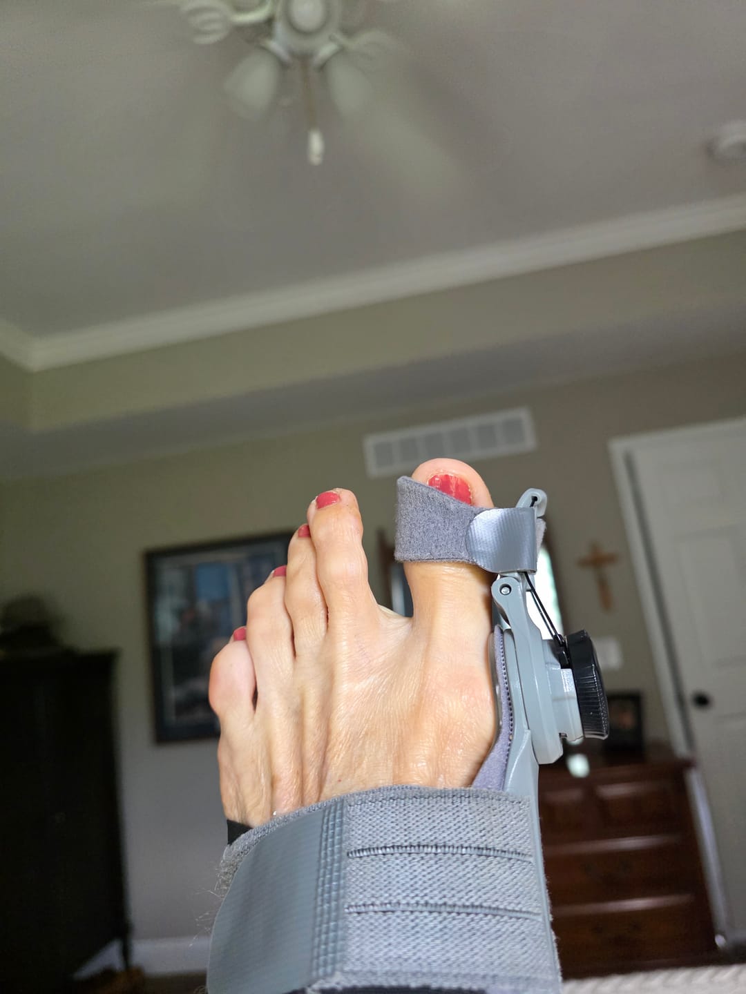 Customer photo review of Treatmedy™ Bunion Fix