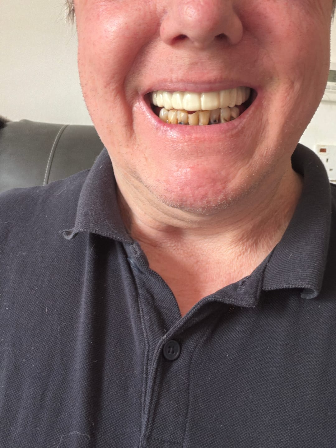 Customer photo review of Click-in Veneers 4.0