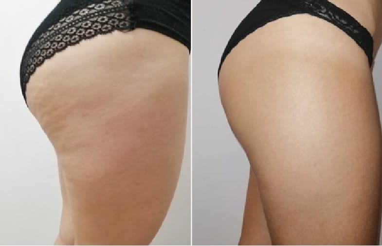 Customer photo review of Nordlys™ 3D Shape Short