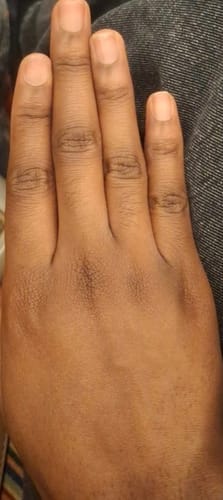 Customer photo review of SÉRUM CORRECTEUR CIBLÉ ANTI-QUINTOS
