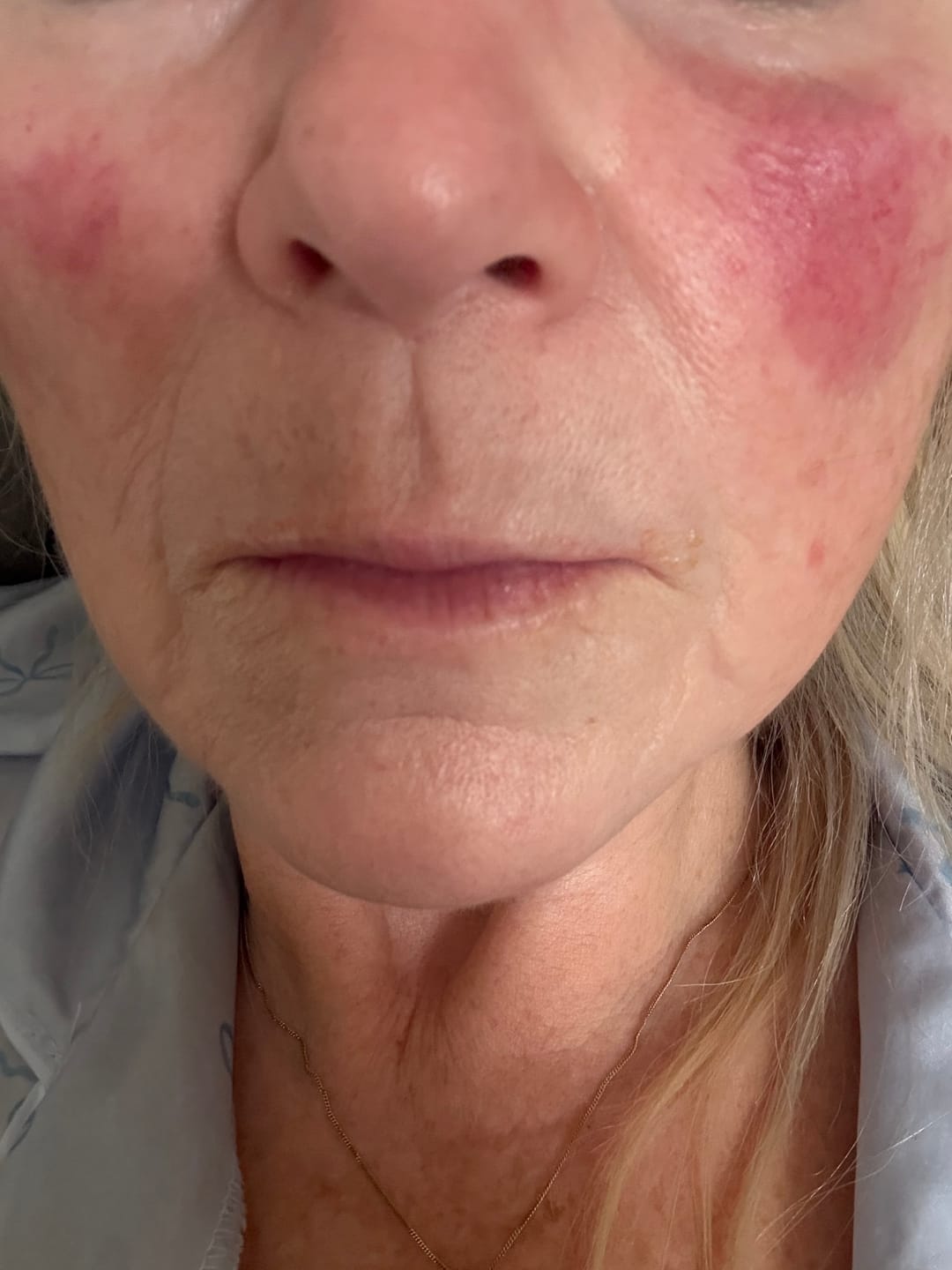 Customer photo review of Rosalique 3 in 1 Anti-Redness Miracle Formula SPF50