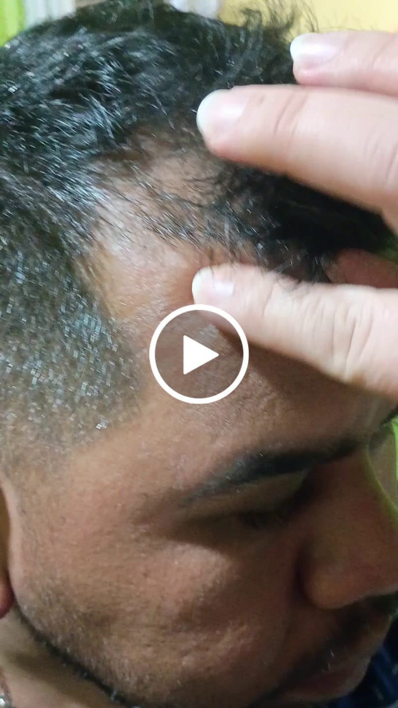 Customer video review of Pack Tratamiento Anticaspa Seca o Psoriasis en Barra