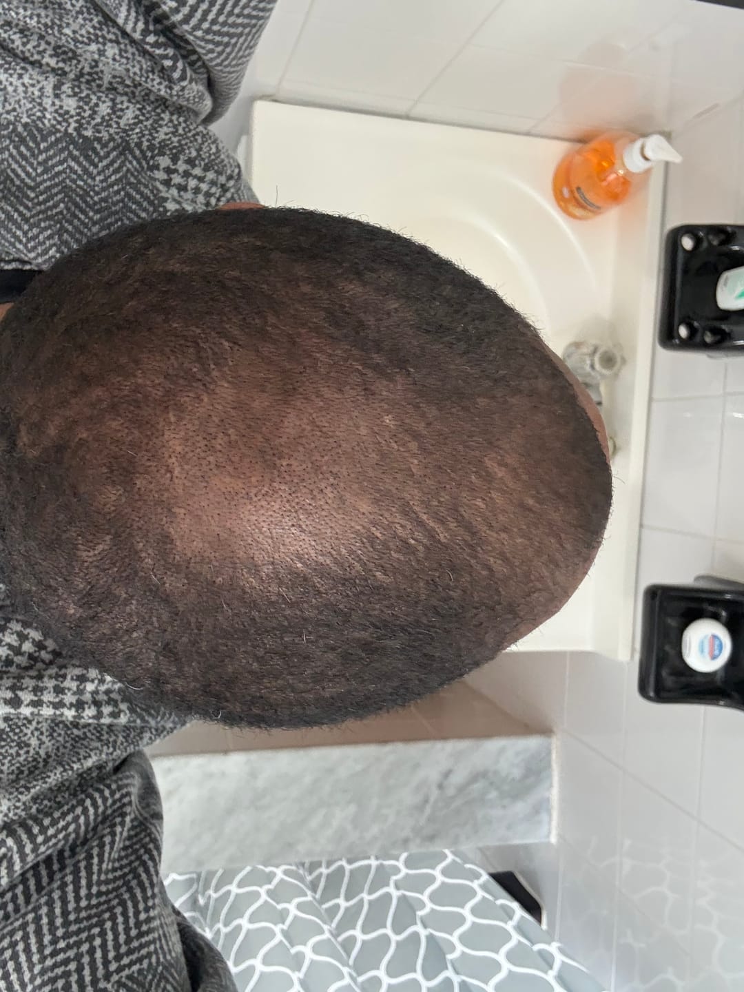 Customer photo review of Rennora EXTRA-Strength Hair Growth Serum