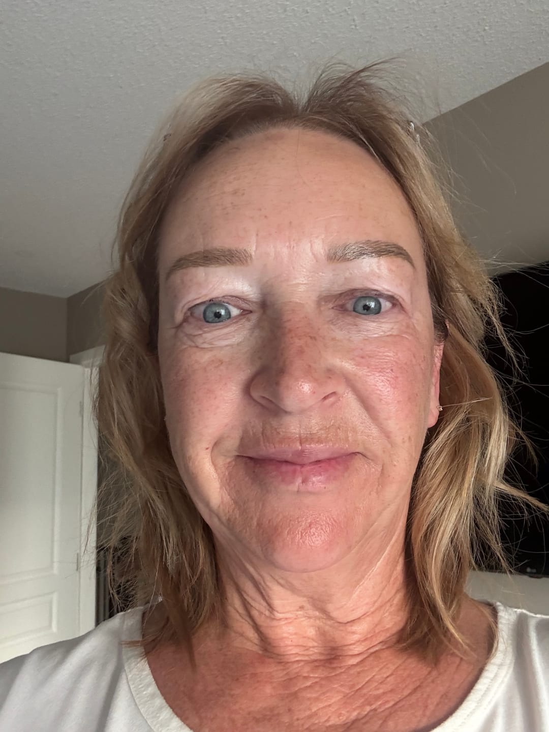 Customer photo review of 3 Month Supply - Seranova Micro Infusion System