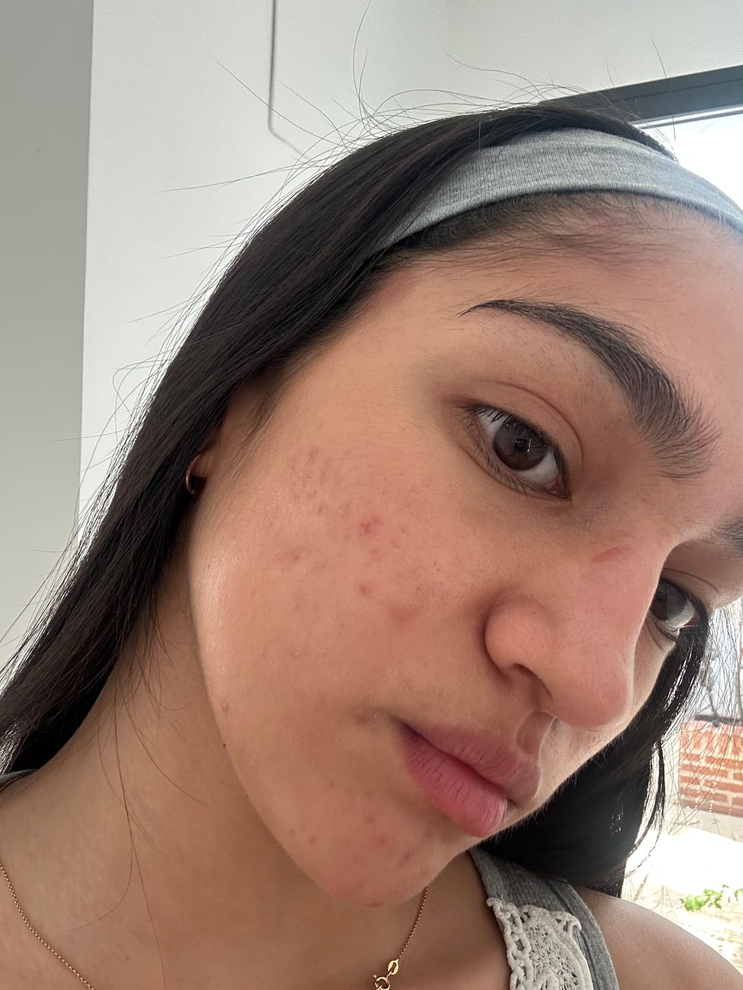 Customer photo review of A CONTROL - ACNÉ HORMONAL & RESISTENCIA A LA INSULINA