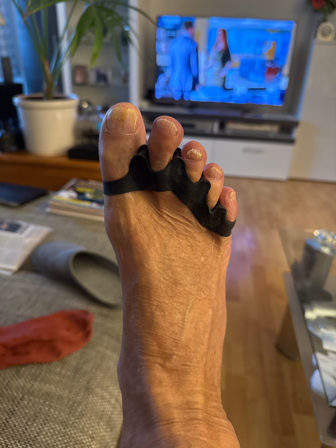 Customer photo review of The Rehab Mechanics Toe Spacers Pack