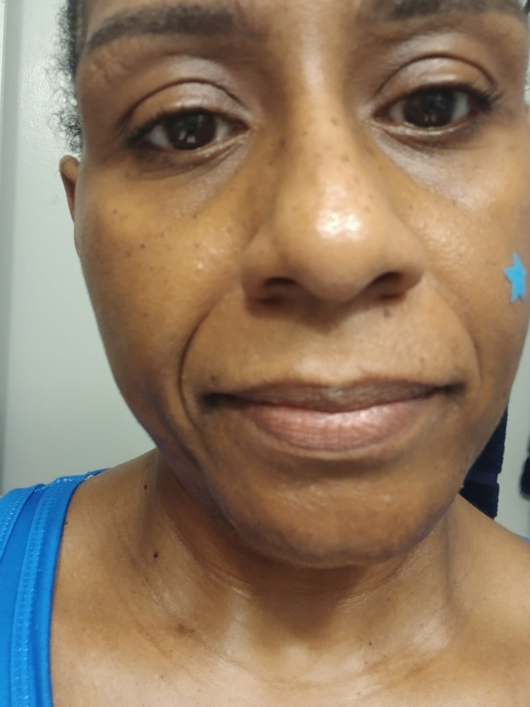 Customer photo review of Facial Moisturizer (Ingrown Hair/Acne)
