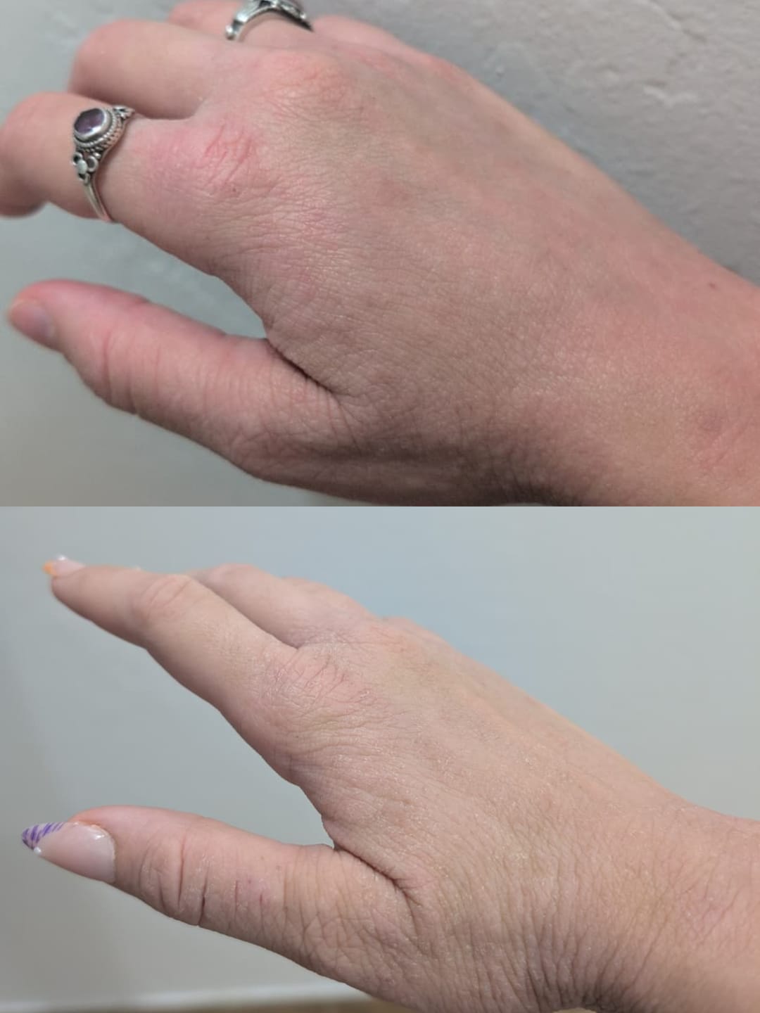 Customer photo review of Eczema Scratch Mitten