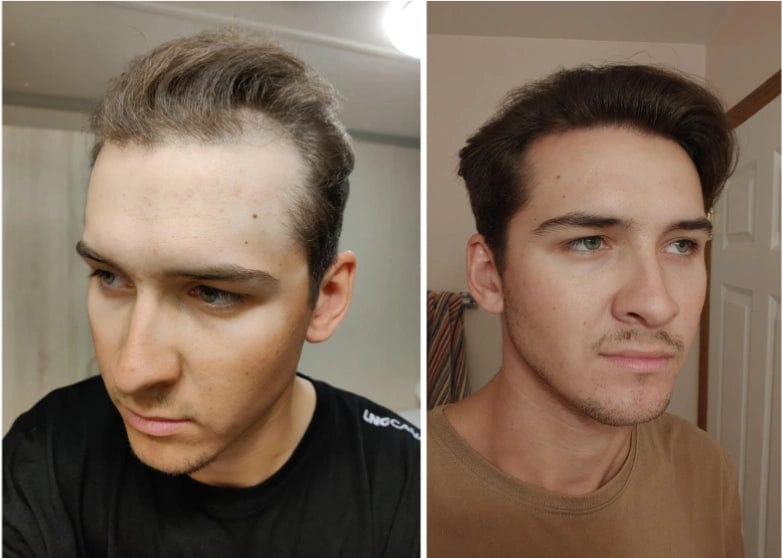 Customer photo review of Apex Hair Growth System
