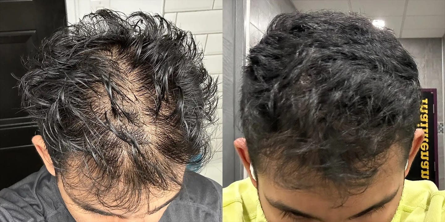 Customer photo review of Apex Hair Growth System