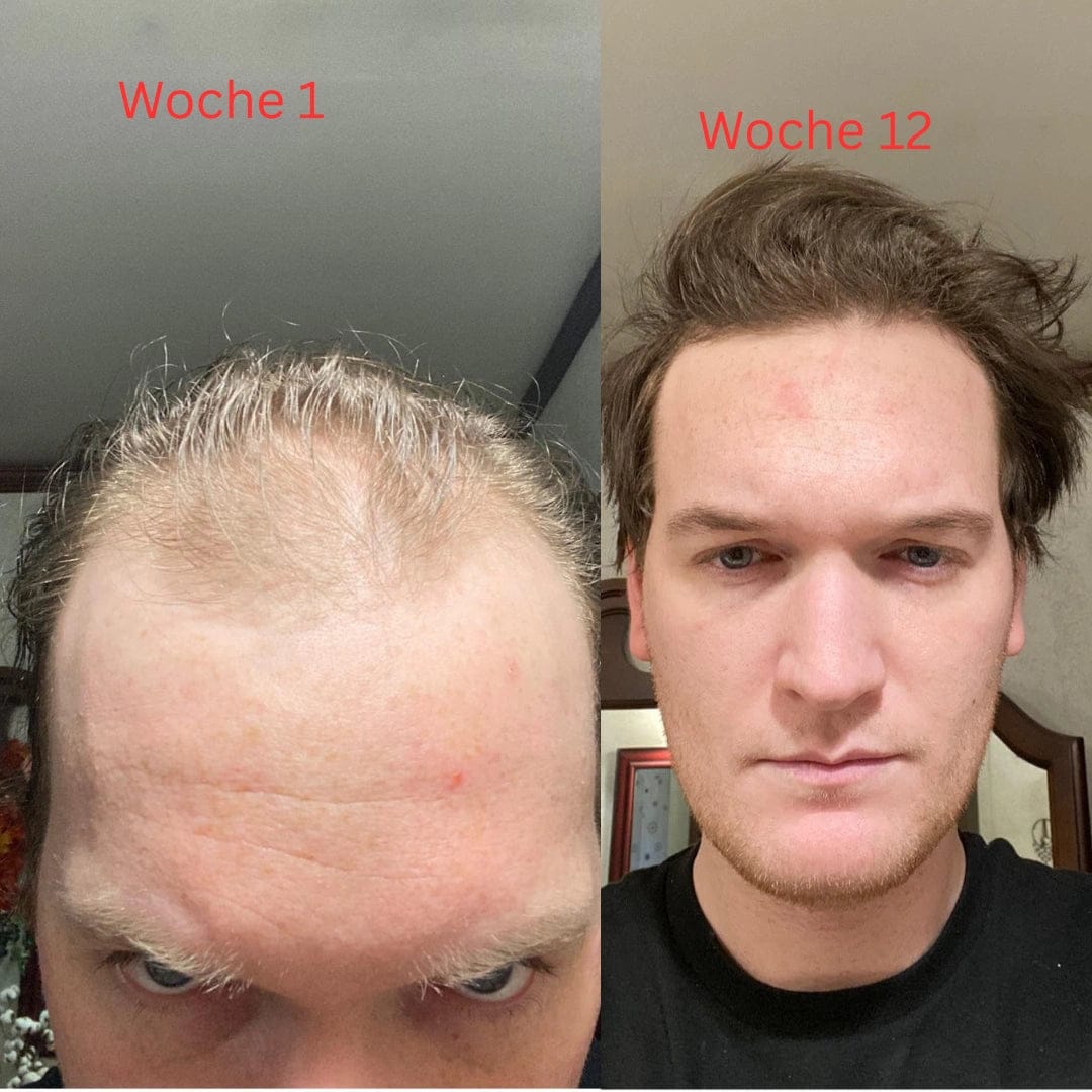 Customer photo review of Apex Hair Growth System