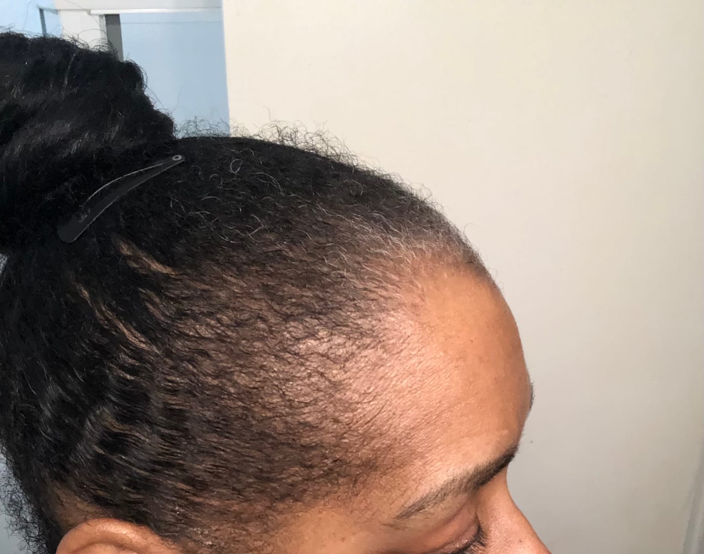 Customer photo review of JUMBO Scalp Stimulator