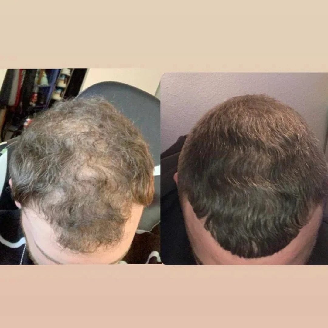 Customer photo review of Apex Hair Growth System
